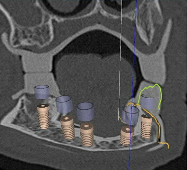 Minimalinvasive 3D-navigierte Implantologie